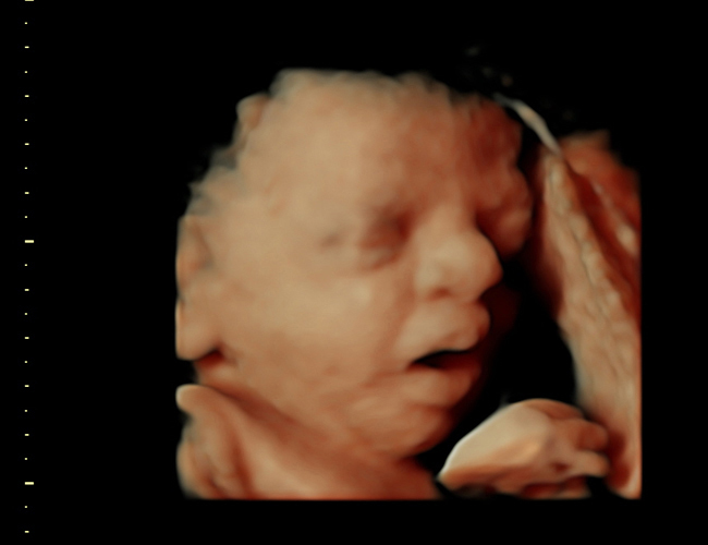 3D ultrasound image at 31 weeks